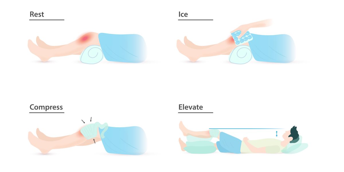 What are the RICE Method’s Impacts on the Healing Process Following Muscle Injuries?