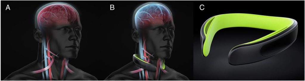 Three panels showing first a red and blue representation of the jugular vein and intracranial venous system, next the compression collar device applied to a model neck and head, and finally the green and black compression collar itself