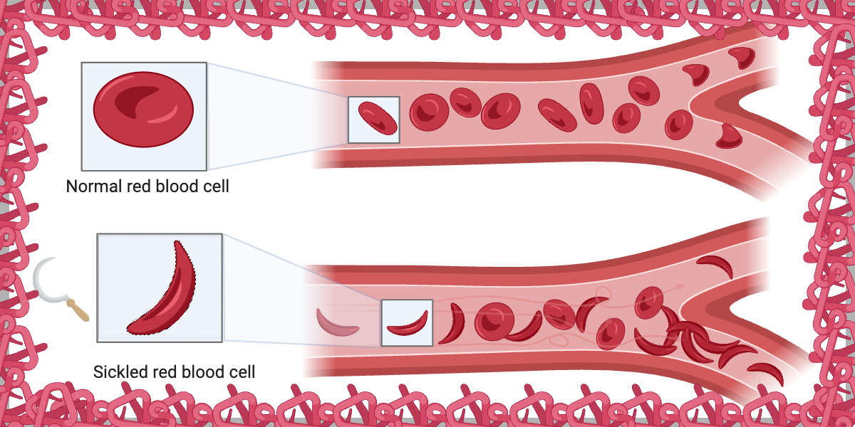 The Hidden Forces Behind Sickle Cells