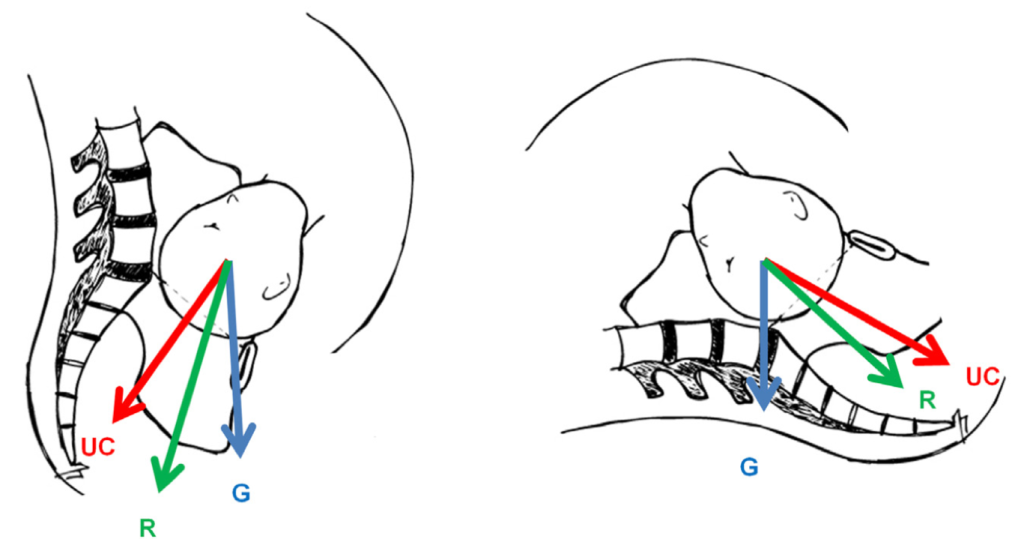 Free body diagrams compare the resultant force of uterine contraction and gravity for upright and horizontal childbirth respectively. Upright childbirth directs forces downward and toward the cervix, while horizontal childbirth directs forces toward the base of the spine. 