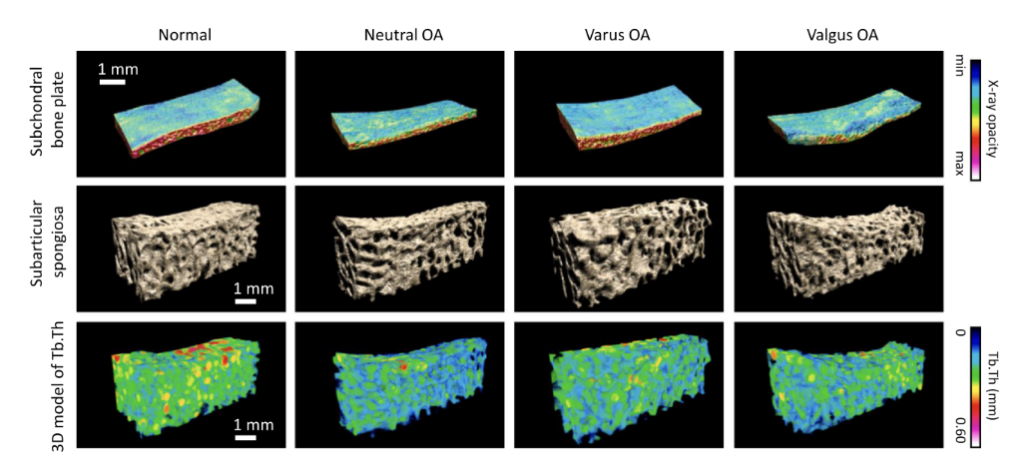 Analysis of bone structures by comparison labeled as: Normal, Neutral, Varus OA and Valgus OA. The first row is labeled as subchondral bone plate and shows plate designs with color scales, the majority showing blue as minimum opacity, with some red. The second row shows different porous materials that are strained differently, depending on which column they are (The Valgus one being squished the most, and the Varus the least), and the last row shows these porous material blocks with color coding that is scaled for a trabecular thickness.