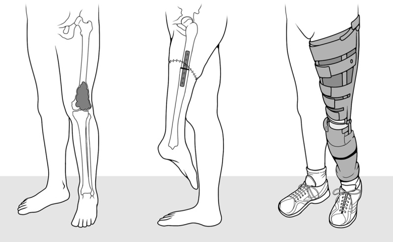 Image of 3 sets of legs.  First set shows a tumor in the right leg at the knee. Second set shows the right leg replaced by rotationplasty. Third set shows the right leg fit with a rotationplasty prosthetic. 