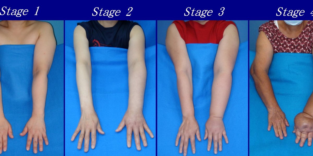 4 pictures side by side of 4 stages of upper limb lymphedema. 2 arms of a person extended out in front of them as swelling increases from left (stage 1) to right (stage 4).