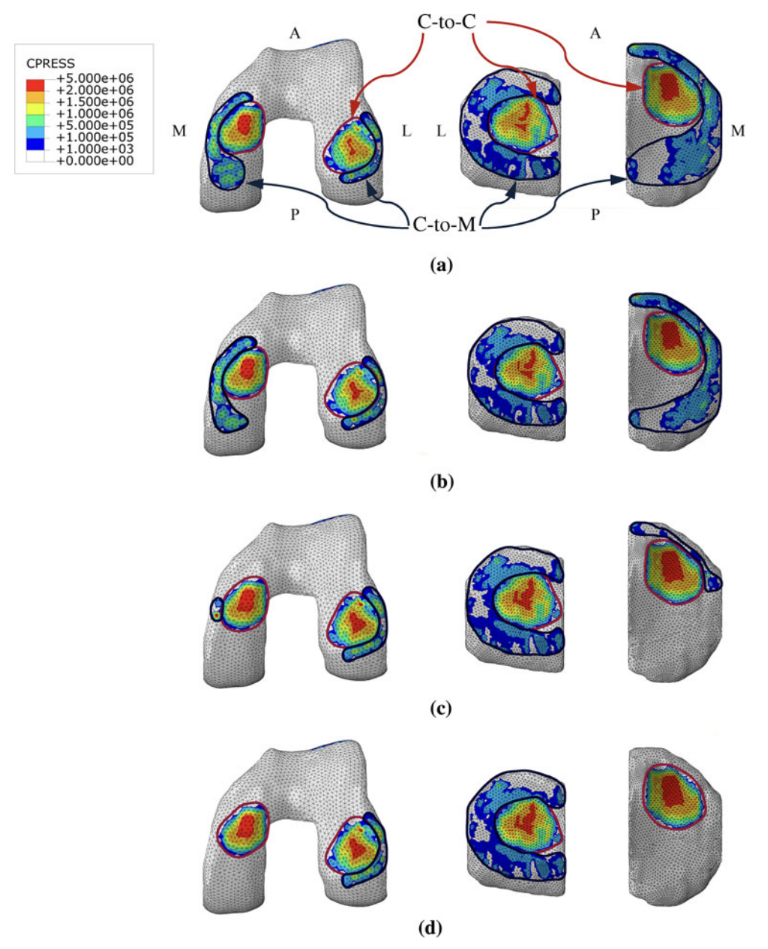 A figure with images of eight U-shaped objects representing a meniscus with a map of colored force magnitudes over it, having 4 total rows. In the first row, the colored mass has a small red core, with orange around it, then yellow around, then green, and finally blue as the final color of the gradient. In the next rows, there is a progressive change of colors, where the red area of the middle of the colored area gets bigger and bigger, while the green and blue areas disappear eventually in the last row. Finally, it includes a legend that indicates an order of numbers where red is 5, orange is 2, yellow is 1, green is 0.5, and blue is zero.