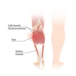 The image shows two legs, one with internal muscles visible. Two groupings of parallel fibers are labeled as "Calf muscle (Gastrocnemius)", with a jagged, black line cutting through the left fibers and labeled as "Tear". Below these fibers, the edges of another muscle labeled "Soleus muscle" are visible and untorn.