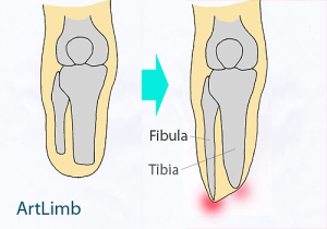 Diagram showing how bone regrowth can cause irritation and eventual stump edema