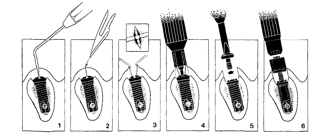 Phase 2 of surgery which attaches a fixture to the screw which is now embedded into the bone