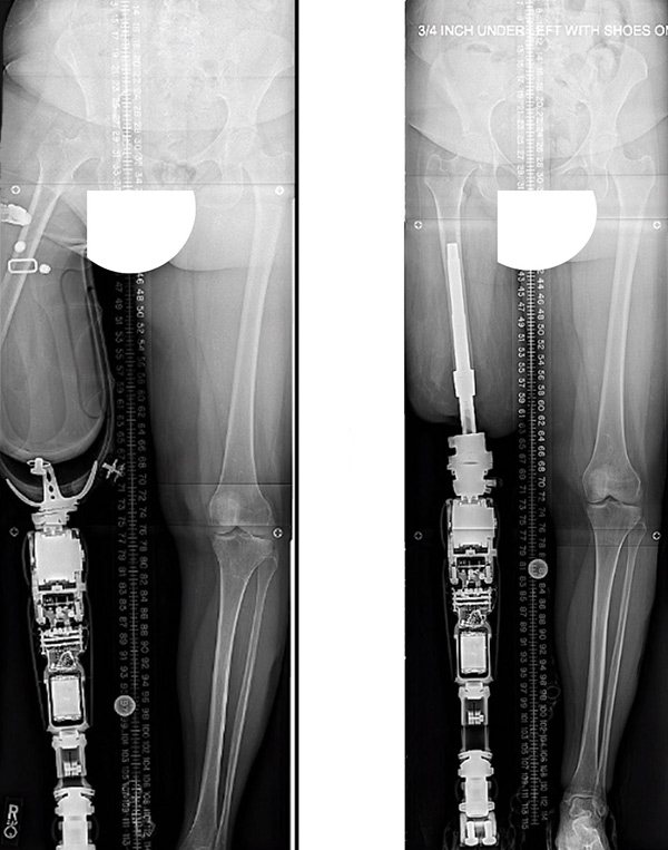 X ray of 2 pairs of legs, left one has a leg in a traditional socket prosthetic device and right has an ossiointegrated device showing the pin anchored in the bone of the leg